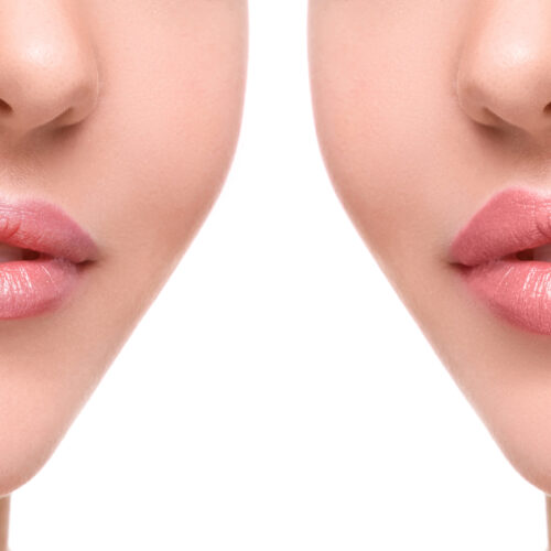 lip neutralization