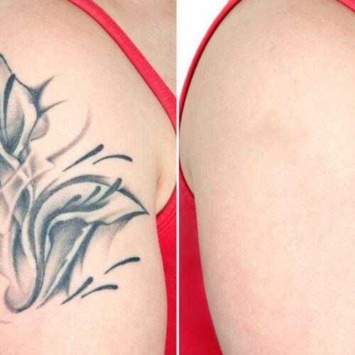 best tattoo removal service