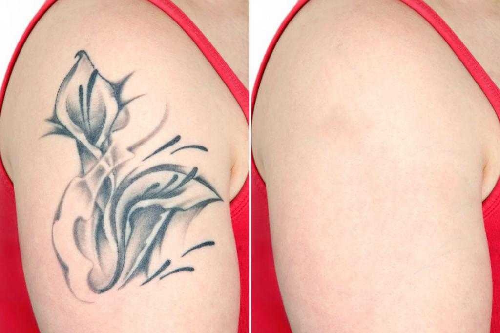 best tattoo removal service